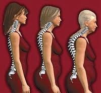 osteoparoza1911121 ПОЗНАВАТЕ ЛИ СВОЯ РИСК ОТ ОСТЕОПОРОЗА